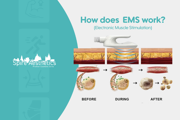 EMS treatment for post pregnancy weight loss treatment Hamilton