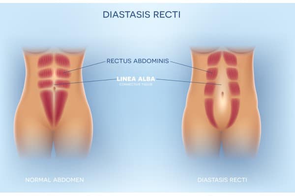 What Non-Surgical Options Are Available for Diastasis Recti Hamilton?