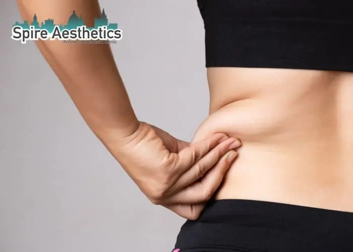 Image of woman pinching fat on their hips Hamilton. Fat Freezing treatment