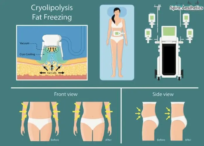 Fat freezing treatment Hamilton benefits for competitions to remove stubborn fat deposits.