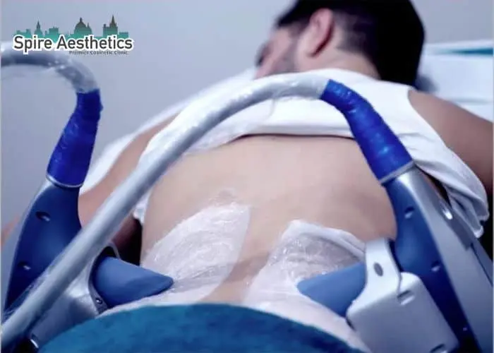 Man having fat freezing treatment done on love handles before a competitions Hamilton to create a sculpted look.