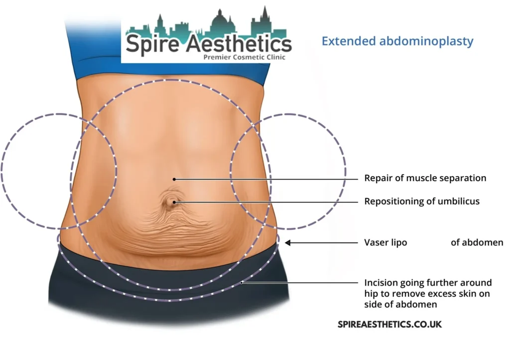 Understanding Loose Skin After Gastric Band Hamilton Surgery and HIFU Treatment