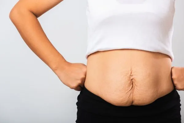 Image of a woman's stomach after weight loss with sagging skin following a gastric band Hamilton