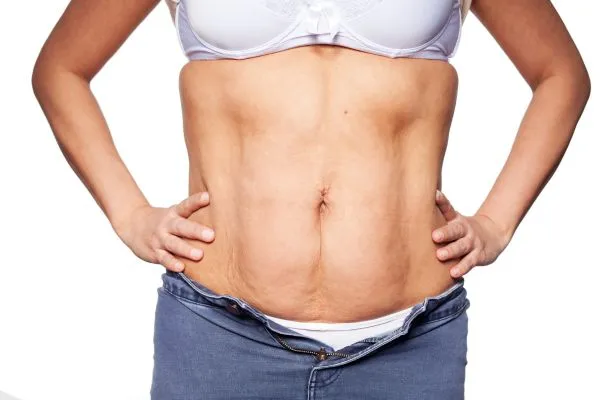 sagging skin on woman's stomach after weight loss injections Hamilton