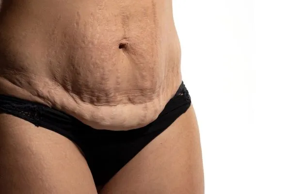 Image of womans stomach after weight loss injections Hamilton showing saggy skin