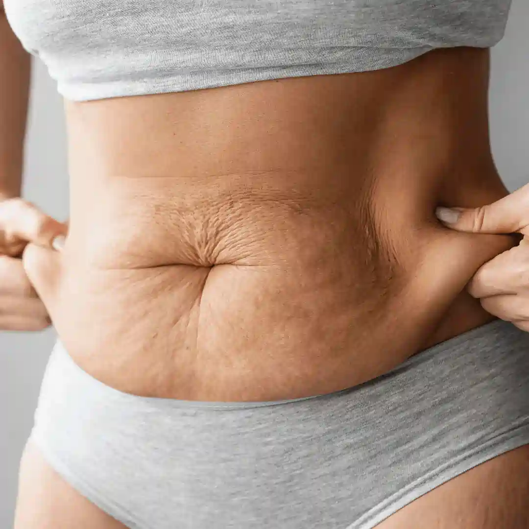 Is It Normal to Have Loose Skin After Pregnancy Hamilton?