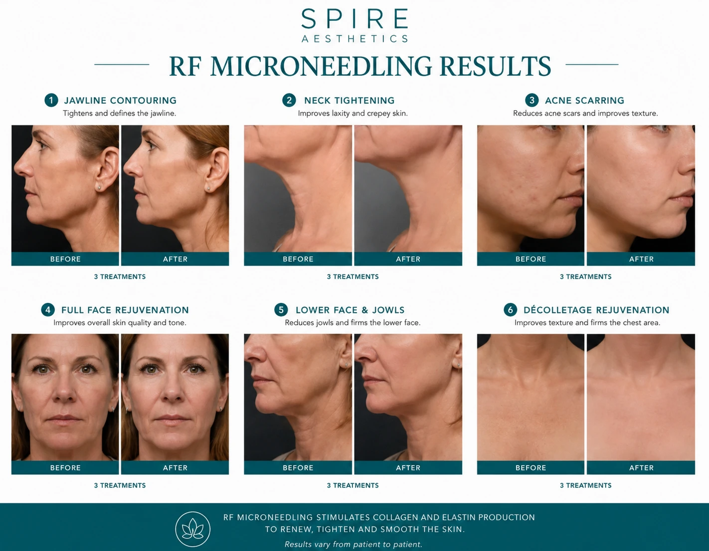 RF Microneedling Skin tightening Hamilton results