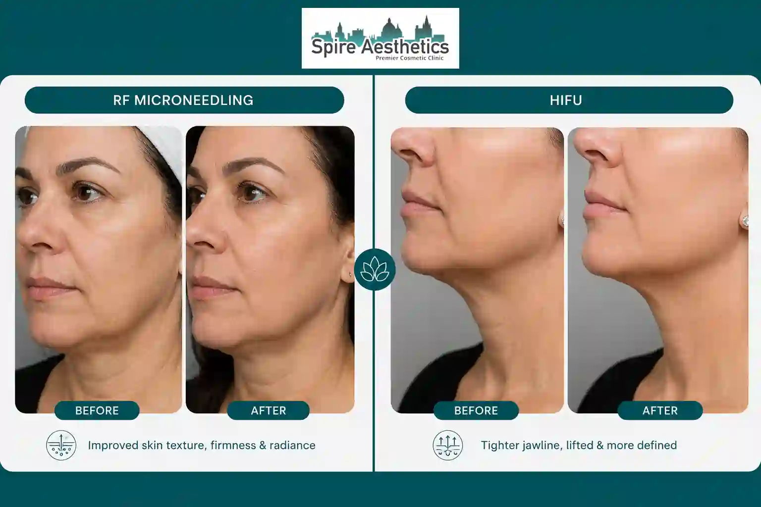 Can RF Microneedling and HIFU Be Combined Hamilton?