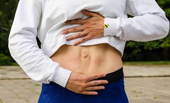 When Could Diastasis Recti Be the Missing Piece of the Puzzle Hamilton?
