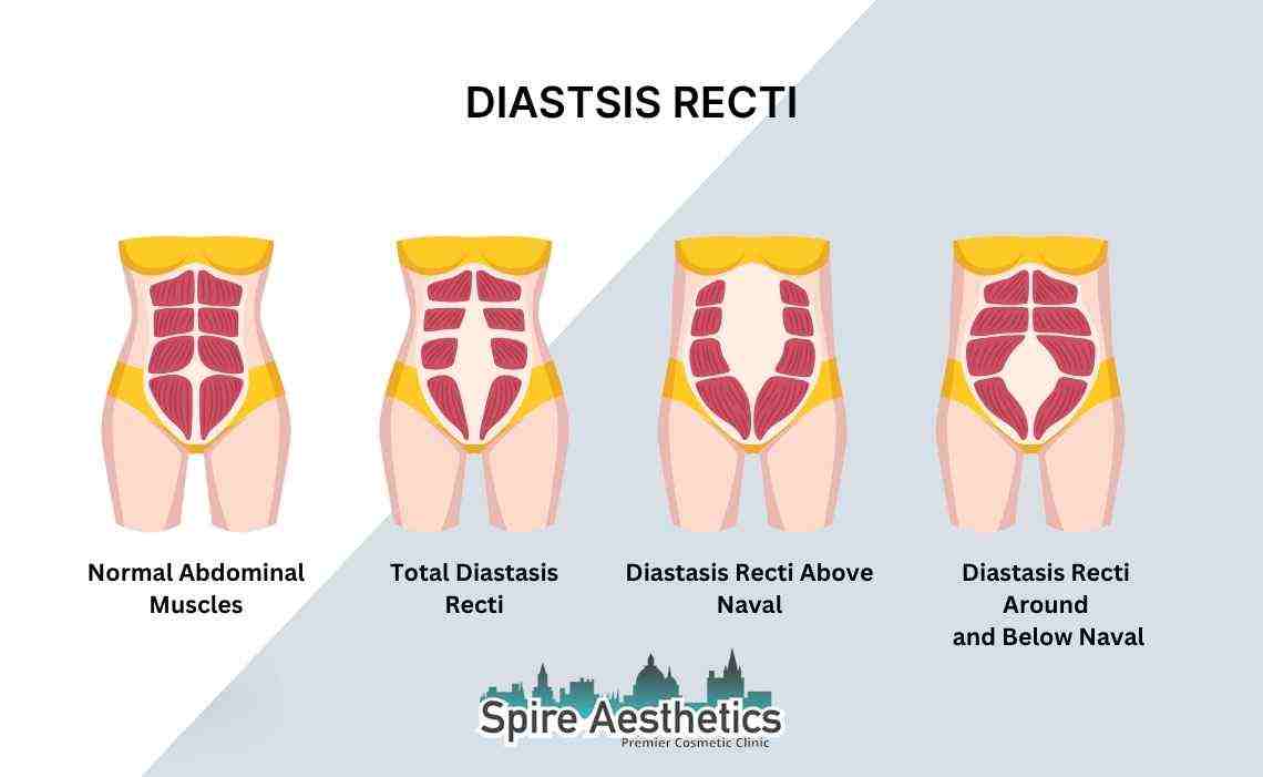 Is Non-Surgical Diastasis Recti Treatment Right for You? Common Concerns Answered Hamilton